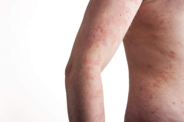 Psoriasis on the body
