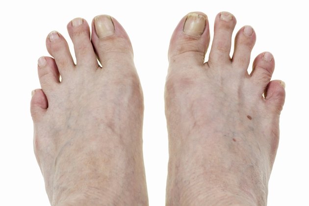 Feets and broken nails