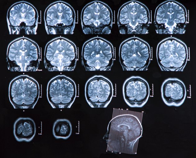 Mri Brain Scan
