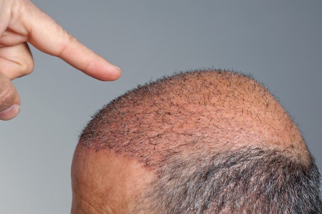 hair transplant