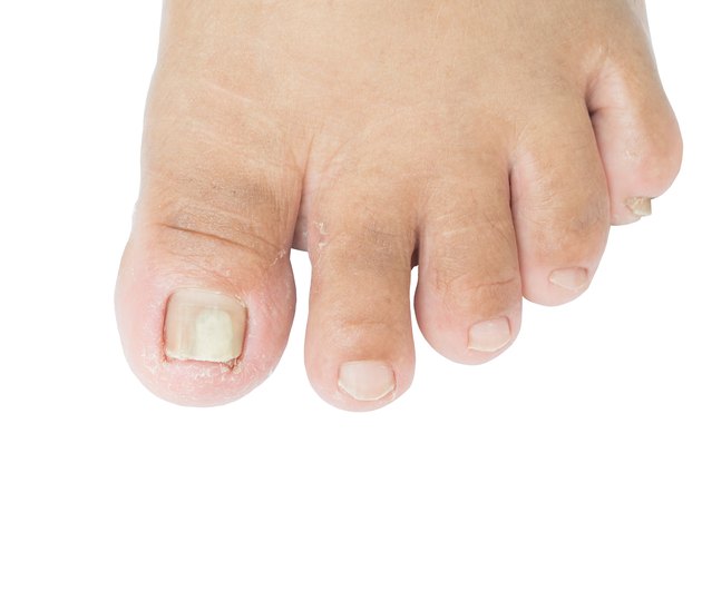 foot fungus
