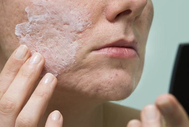 Acne treatment