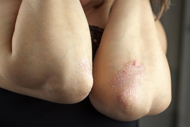 Psoriasis on elbows