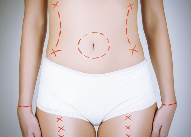 Cosmetic surgery-body marks