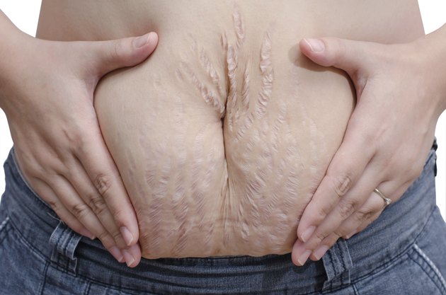 Asian woman showing her stretch marks
