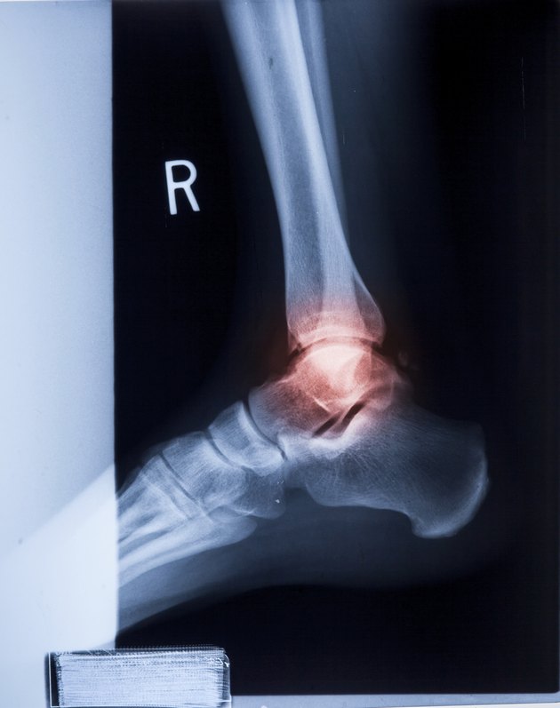 Ankle feet & knee joint pain X-ray MRI photo film