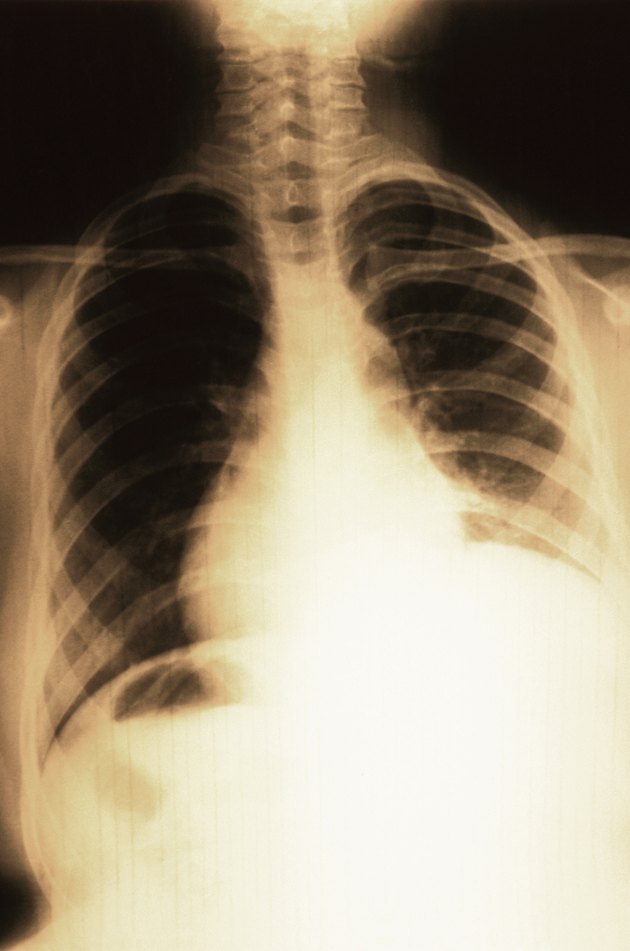 x-ray of chest