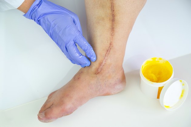Human leg with postoperative scar of cardiac surgery