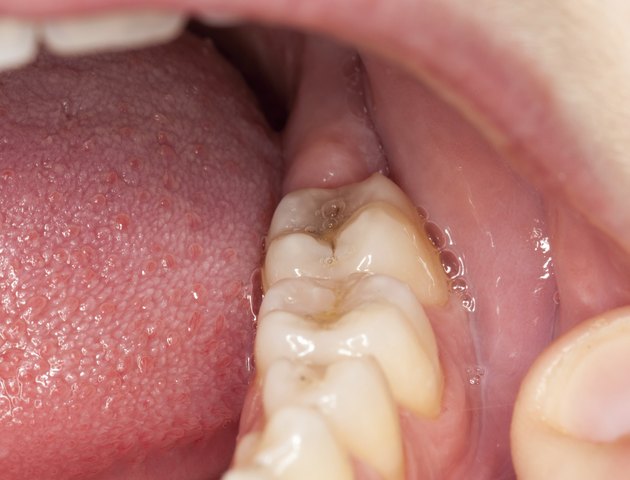 Macro image of filled teeth