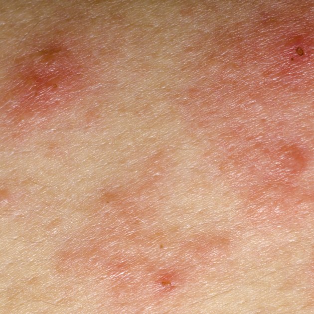 Diseases that Cause Eczema | Livestrong.com