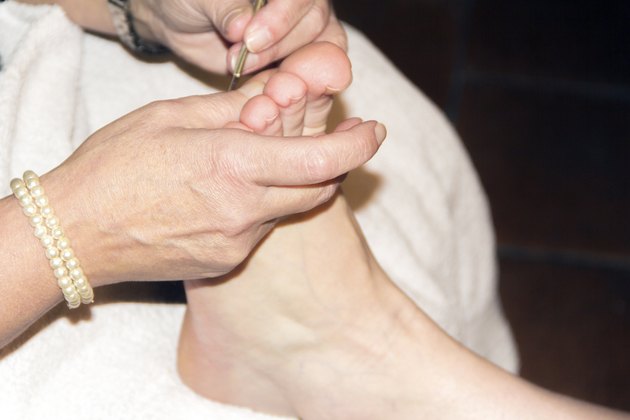 callus removal