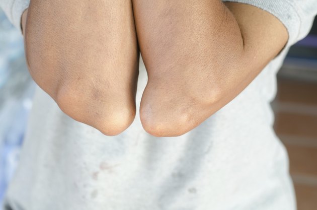 elbow of patients with gout.