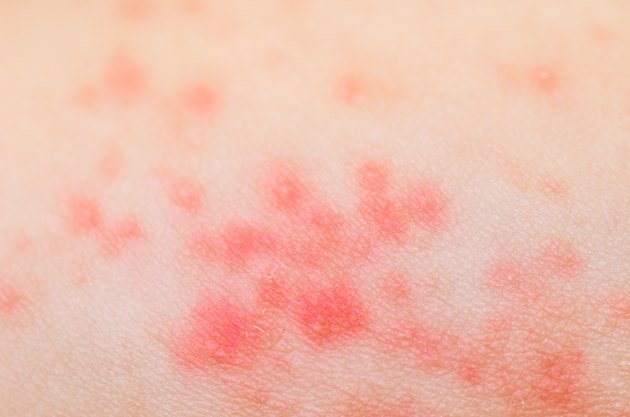 ill allergic rash dermatitis eczema skin texture