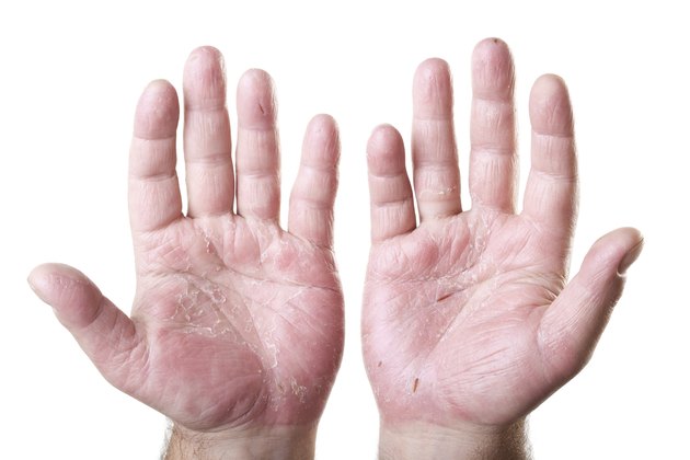 two male palms with eczema isolated on white background