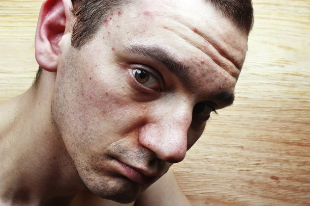 Acne pimples on the face