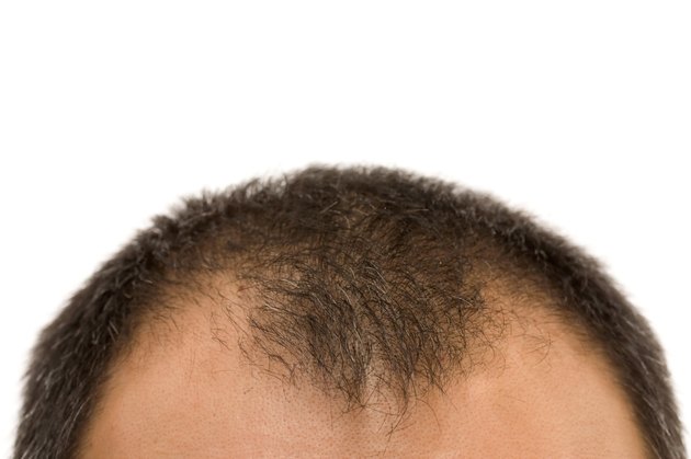 getting bald
