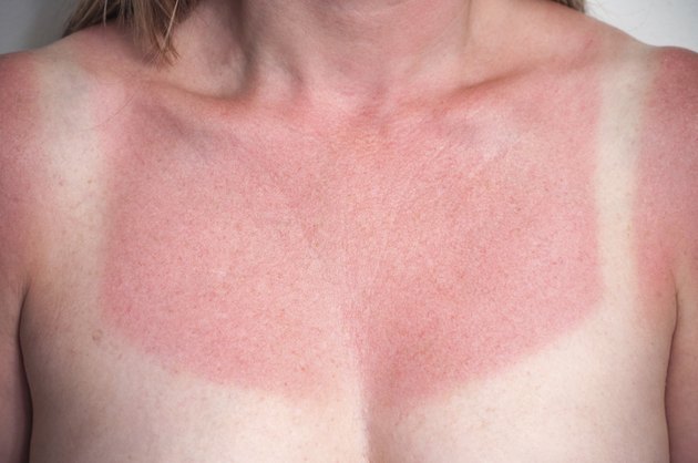 Can Lavender Oil Help Sunburn? | Livestrong.com