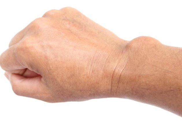 Close-up cyst on the hand