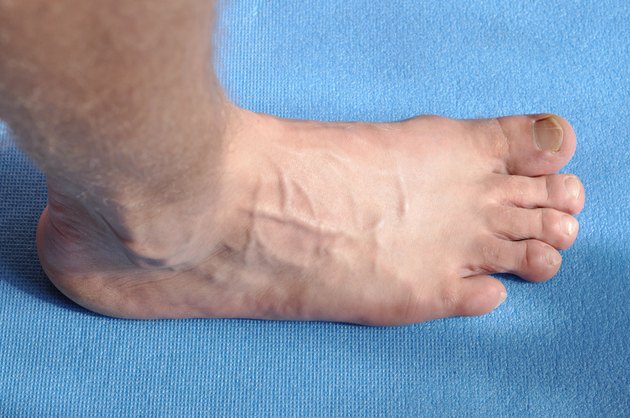 Toenail fungus with varicose veins