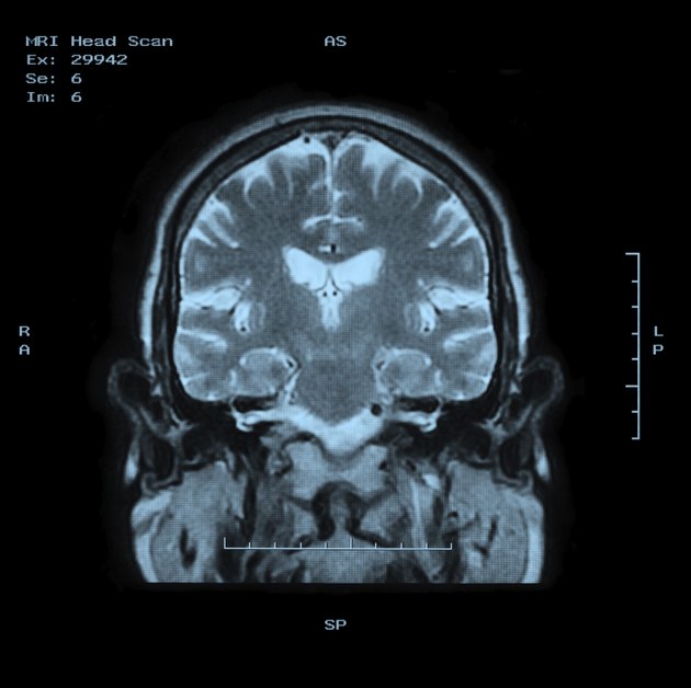 MRI Head Scan Back view