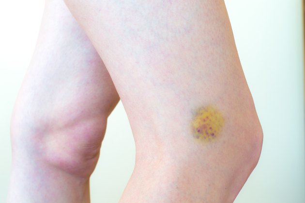 Bruised skin, a leg with pain
