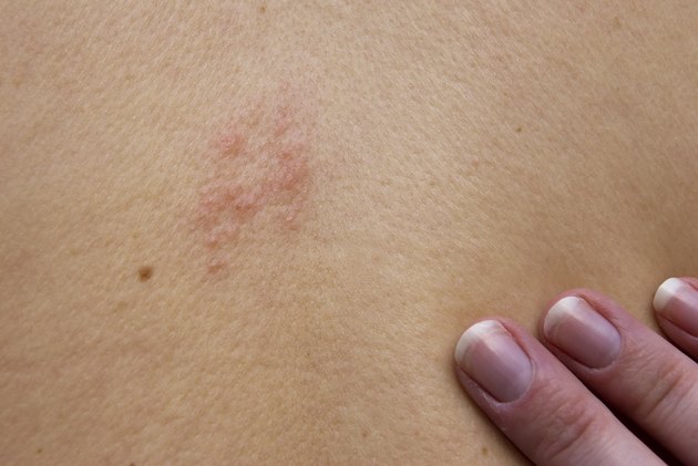 How To Get Rid Of Shingle Scars 8470