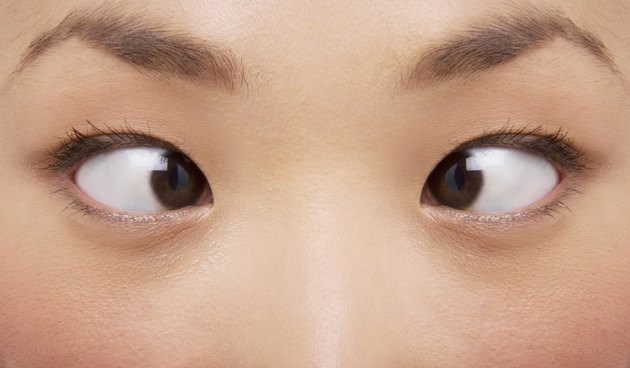 Cross Eyes Young Woman