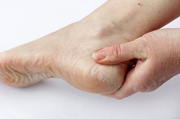 woman has dry skin and calluses on the feet