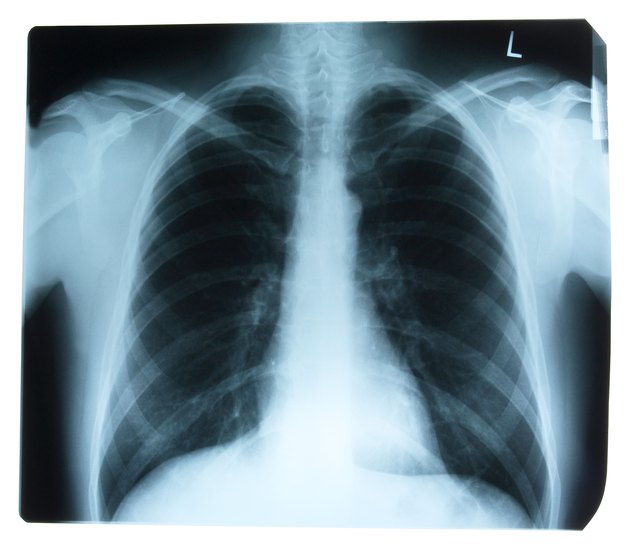Chest x-ray