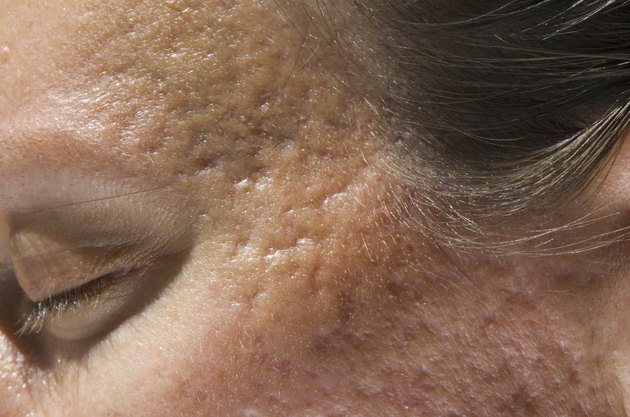 Acne scars