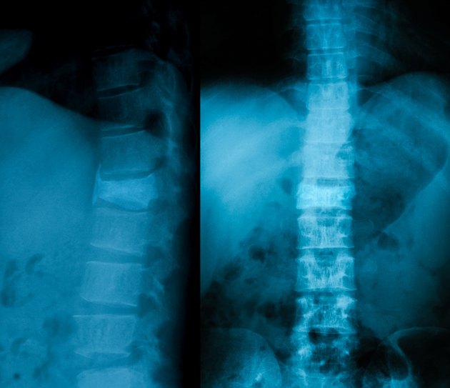 X-ray image of vertebral column.