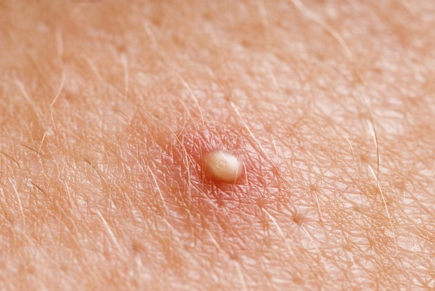 whitehead zit