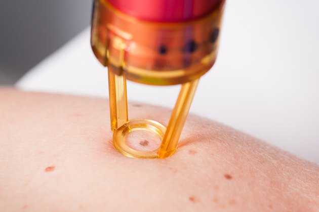 Removing mole by medical laser