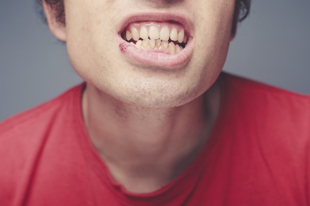 Young man with cold sore and plaque on his teeth