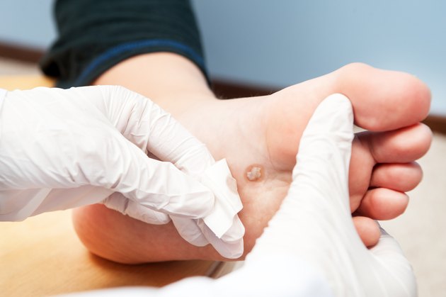 wart