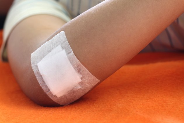Wound sealed with plaster