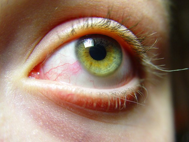 Irritated female eyes close-up