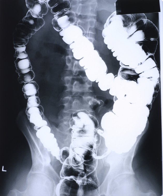 Xray colon