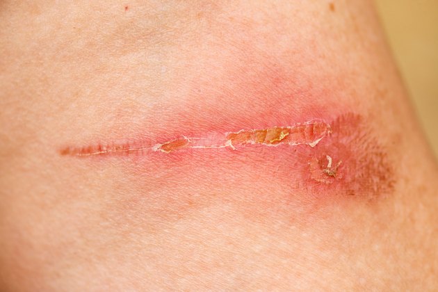 Burn Scar Detail