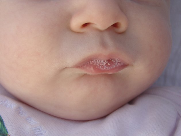 Can Babies Get Blisters On Their Top Lips From Breastfeeding 