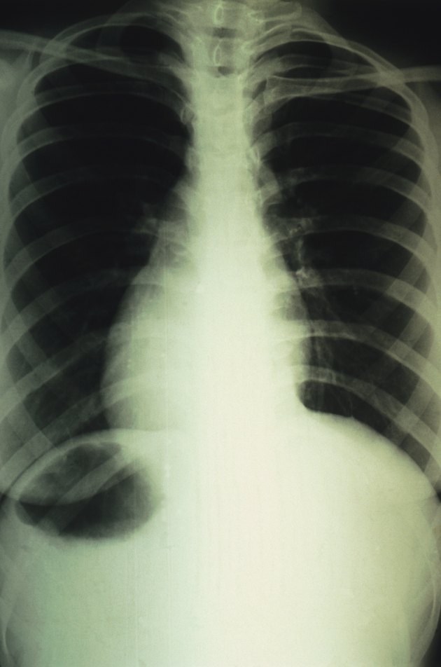 x-ray