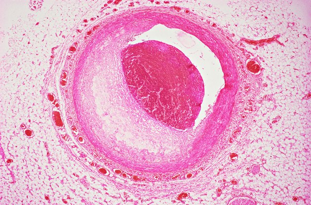 Coronary artery