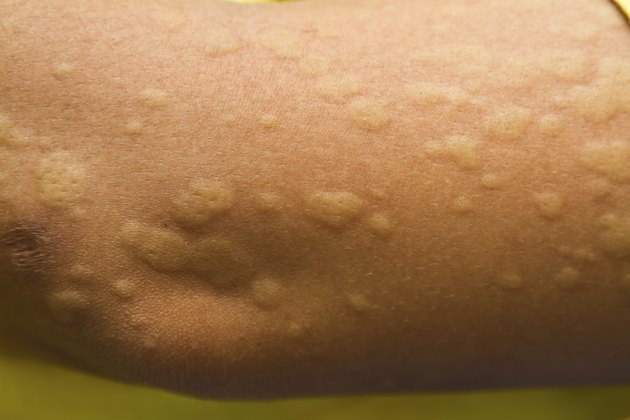 Full Body Rash After Eating