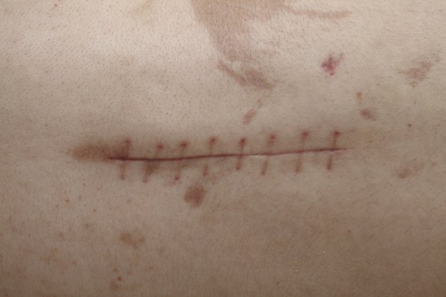 Back Surgery Scar