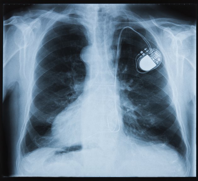 X-ray