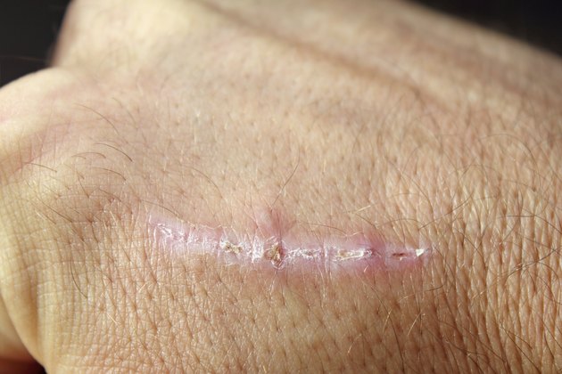 scar on man hand