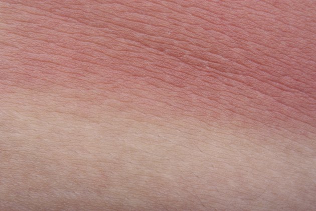 Example sunburn skin