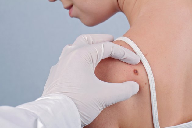 Doctor dermatologist examines birthmark of patient close up