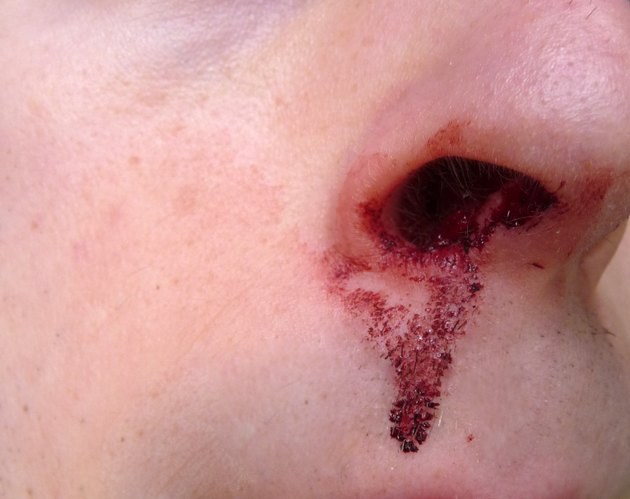 Nose Bleed 1