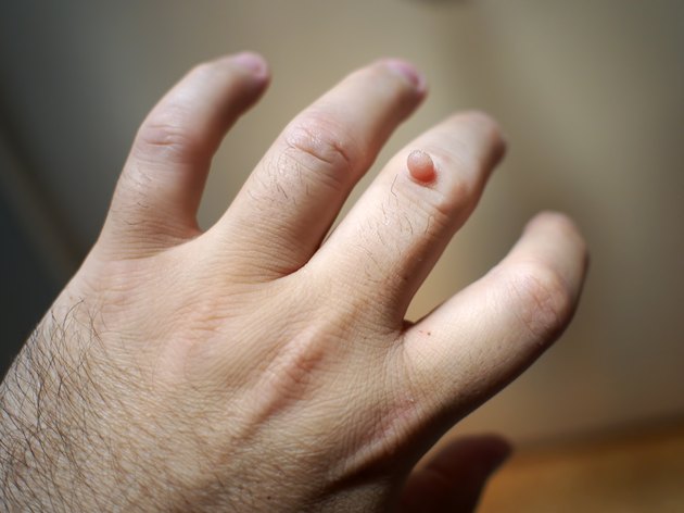 Wart on the hand